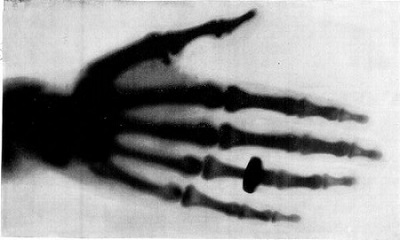 X-ray scan of a human hand. The hand is wearing a ring.