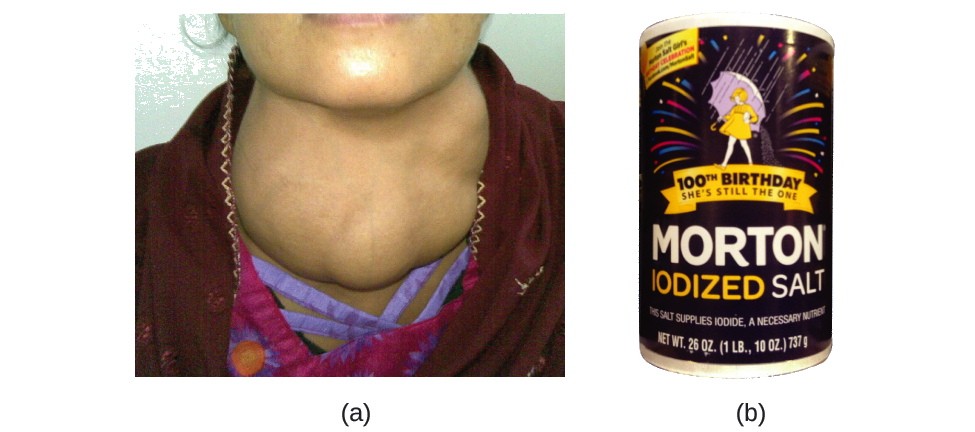 Figure A shows a photo of a person who has a very swollen thyroid in his or her neck. Figure B shows a photo of a canister of Morton iodized salt.