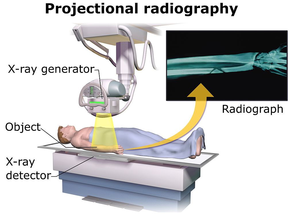 A diagram of projectional radiography. An x-ray generator points downward at an "object", the patient's arm, that is laying on an x-ray detector. The radiograph produced shows that the patient has broken their ulna.