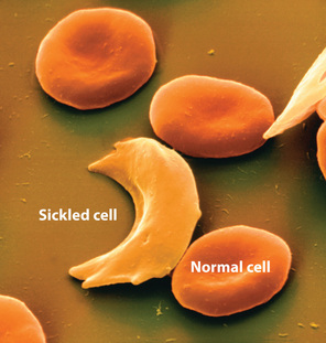 A normal blood cell is circular in shape with a dimple in the middle, a sickled cell is banana shaped. 
