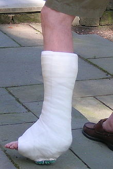 Leg in a white leg cast.