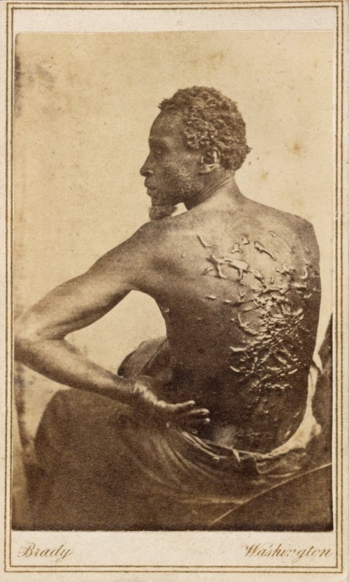 A view of a slave's back. It is completed covered with raised scars.
