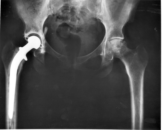 X-ray of a pelvis, showing bright white titanium replacement femur.