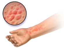 220px-Urticaria.png