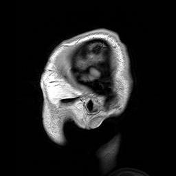 Parasagittal_MRI_of_human_head_in_patient_with_benign_familial_macrocephaly_prior_to_brain_injury_(ANIMATED).gif