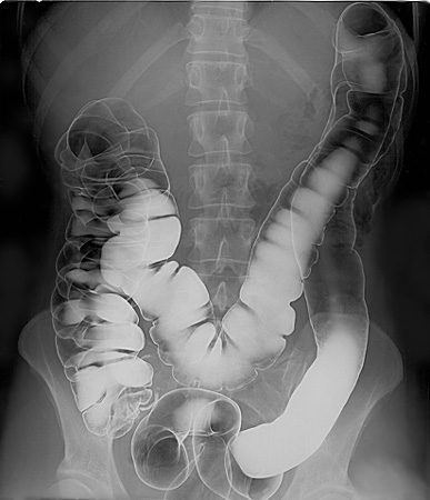 Drinking barium milkshakes shows the intestines more prominent than bones in x-rays.