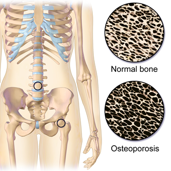 A normal bone cross section is shown compared to a much more porous bone with osteoporosis.