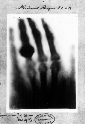 First_Medical_X-Ray_por_Wilhelm_röntgen_de_su_esposa_anna_bertha_ludwig' s_hand_-_18951222.gif