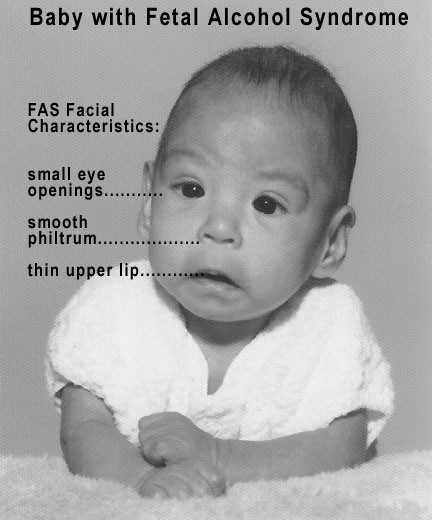 This is a photo of a baby with fetal alcohol syndrome Alcohol is a teratogen. When consumed in pregnancy, it can result in mothers giving birth to children with fetal alcohol syndrome. The facial characteristics highlighted in the photograph are a small eye opening, a smooth philtrum, and a thin upper lip.
