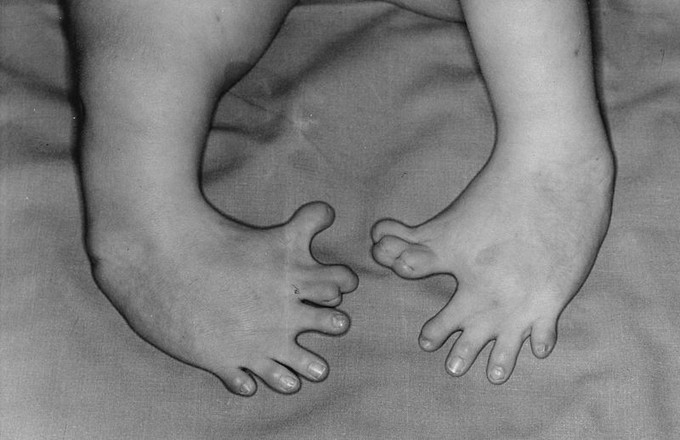 A photograph of the limbs of baby born to a mother who took thalidomide while pregnant. The feet are curved inwards and have seven misshaped toes.