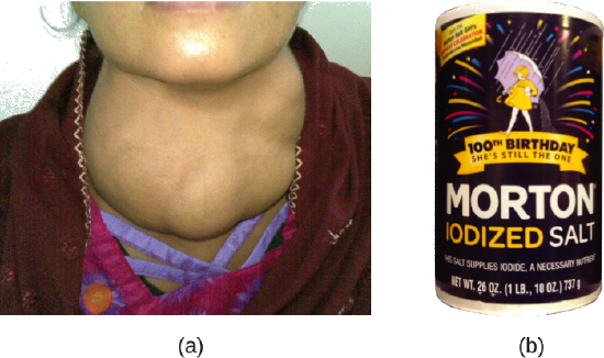 Figure A shows a photo of a person who has a very swollen thyroid in his or her neck. Figure B shows a photo of a canister of iodized salt.