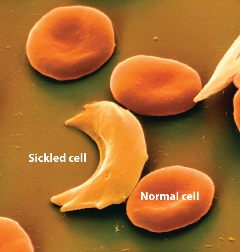 Ejemplos de un glóbulo falciforme y un glóbulo normal.