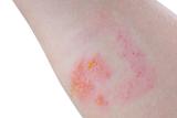 Skin contact with leaves of poison ivy can result in a blistering rash.