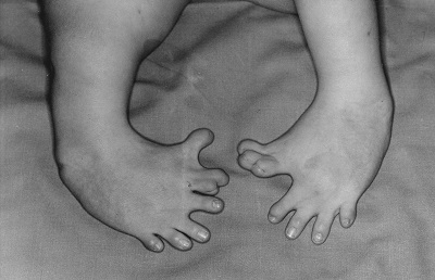Image of a baby's feet with birth defects. Each of the baby's feet has 7 mishapen toes.
