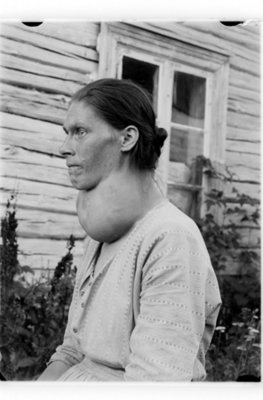 Retrato en blanco y negro de una mujer con bulto extremadamente hinchado abultado en la zona del cuello.