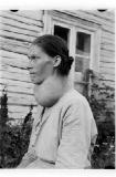 Black and white portrait of a women with extreme swollen lump bulging out in the neck area.