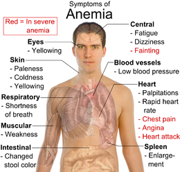 260px-Symptoms_of_anemia.png