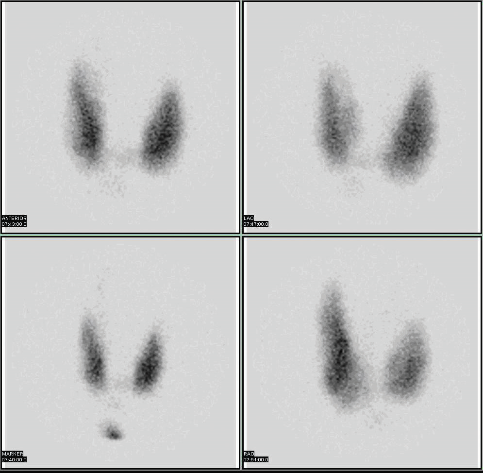 Isótopos radiactivos, mostrados en una gammagrafía diagnóstica de glándula tiroides.